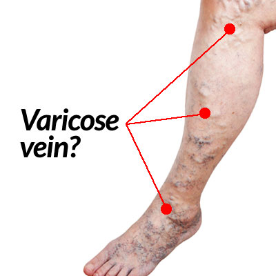 Tips to prevent varicose veins Tips to prevent varicose veins