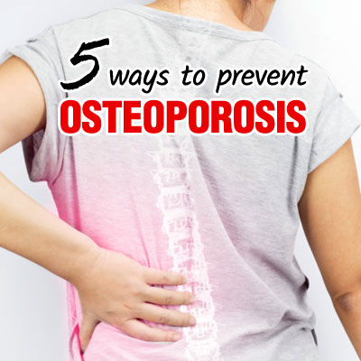 5 Ways to Prevent Osteoporosis 5 Ways to Prevent Osteoporosis