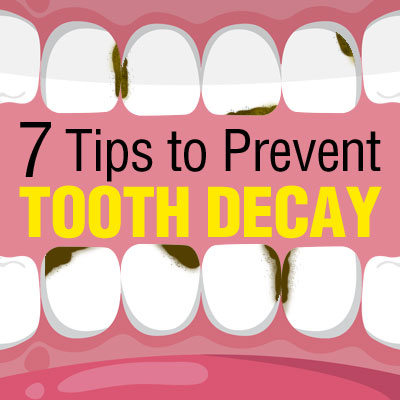 7 Tips to Prevent Tooth Decay 7 Tips to Prevent Tooth Decay