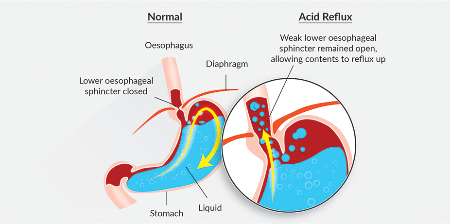 gastric pain solution