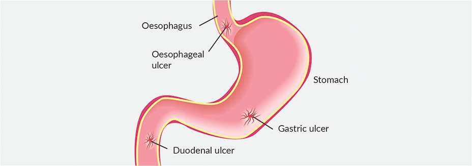 gastric pain solution