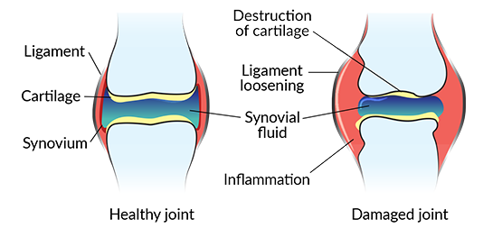 Diagram on Wear and Tear of Joints and Cartilage